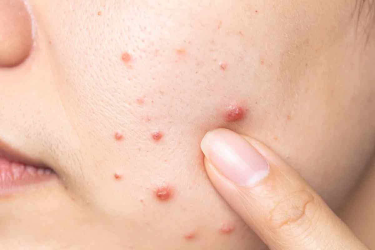 brufoli sul viso