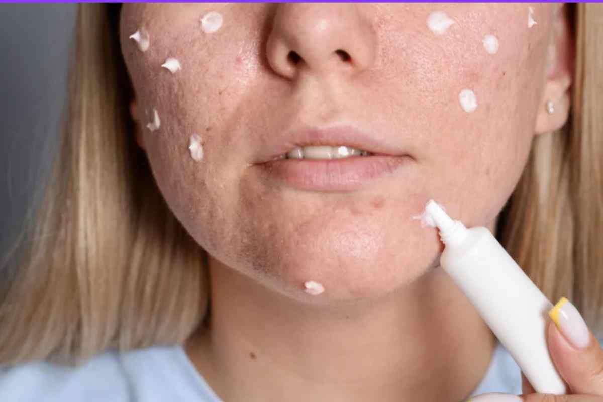 crema brufoli sul viso